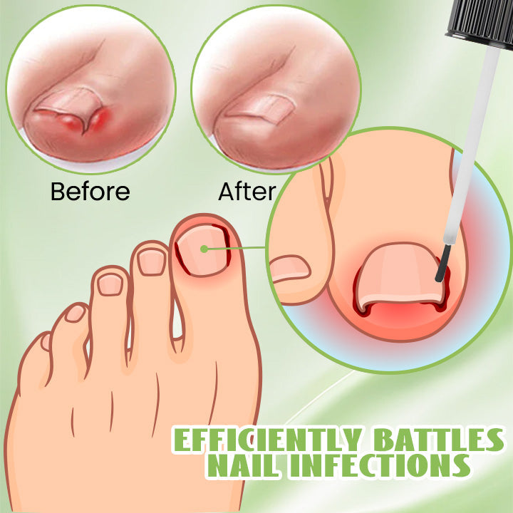 Biancat™ FungiFix Nail Fungus Nourishing Treatment Liquid