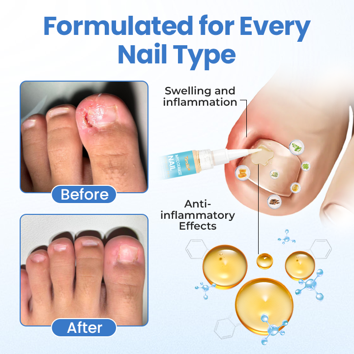 Timilk® MycoErase Nail Revive Pen
