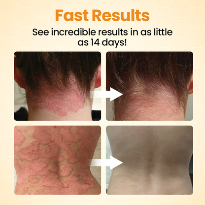 Timilk® BeeLieve Psoriasis Skin Care⭐
